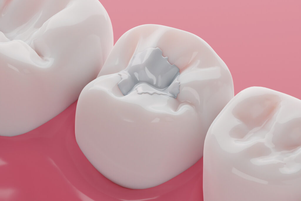 3D-Modell Zahnfüllung in Zahn