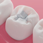 3D-Modell Zahnfüllung in Zahn