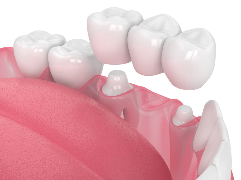 3D Render Zahnbrücke in Kiefer vor weißem Hintergrund