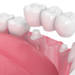 3D Render Zahnbrücke in Kiefer vor weißem Hintergrund
