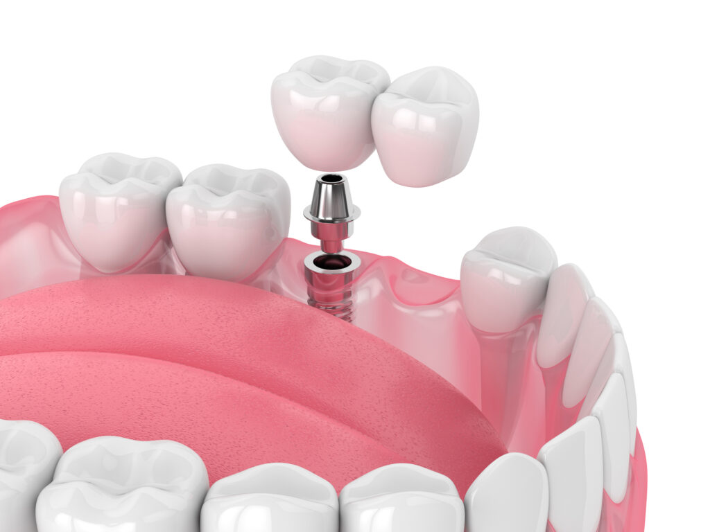 3D Render von Kiefer mit Zahnimplantat und Zahnbrücke