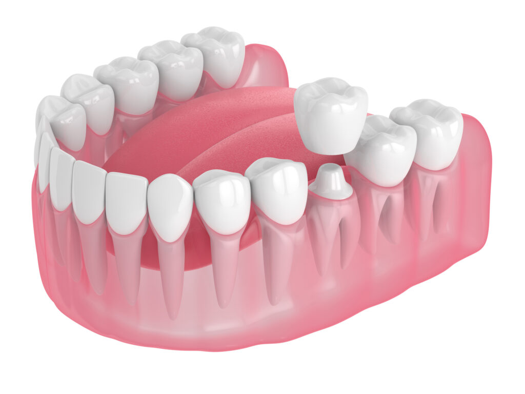 Zahnkronen mit Restaurierung über weißem Hintergrund in Zahnarztpraxis Bremen